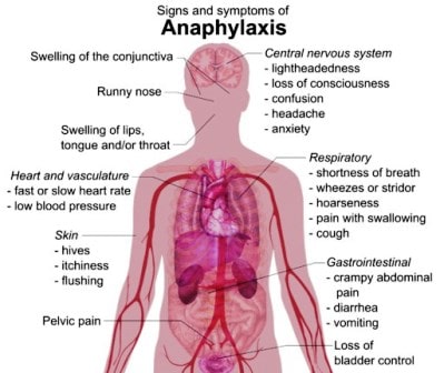 How to predict biphasic allergic reactions in children 