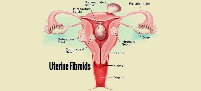 fibroids